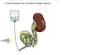 Urosonografia miccional [upl. by Eradis]