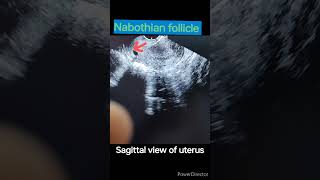 Nabothian follicle in cervix cervix cervicitisultrasound sonography doctor [upl. by Quartis]