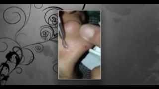 Huge Blackheads Pop on Nose  Black head [upl. by Myrt278]