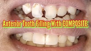 Anterior Tooth Filling With COMPOSITE  TEETH SMILE RESTORATION [upl. by Layman]