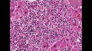 Histopathology LiverAcute myeloid leukemia [upl. by Tychonn]