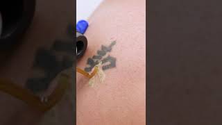 Laser Tattoo Removal Process [upl. by Tollman]