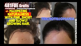 481GraftsTrichotillomania Female frontline restoration 10mths updateInjertocapilarcom28922023 [upl. by Selby826]