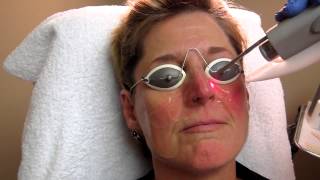 Nd YAG Laser Treatment for Rosacea at Total Body Care [upl. by Eisnyl]