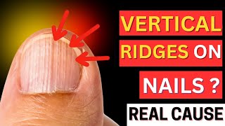 Thats The REAL Cause of VERTICAL RIDGES On Your Nails [upl. by Baillieu]