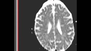 MRI Diffusion imaging ACUTE stroke DISCUSSION by Radiologist [upl. by Anaitsirhc]