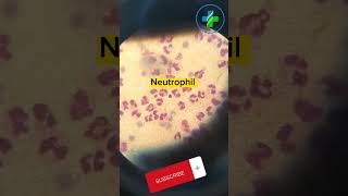 High neutrophil count in peripheral smear  neutrophils  CBC  Causes of Neutrophilia  hematology [upl. by Aviv]