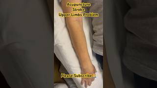 Acupuncture  Stroke  Upper Limbs Problem viral tcm acupuncture dr shorts shortsfeed [upl. by Gallard]