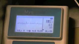 Myoguide and Ultrasound Guided Piriformis Syndrome Injection [upl. by Aysan]