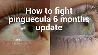 How to fight pinguecula update for 6 months [upl. by Miran]