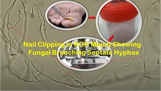 Branching Hyphae of Fungus in KOH mount of Nail Clipping [upl. by Pontone587]