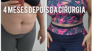 ABDOMINOPLASTIA 4 MESES DEPOIS comoestoubem [upl. by Namyaw]