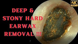 DEEP amp Stony HARD Earwax Removal Very Satisfying Video [upl. by Hillel740]