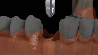 Implant In 2 step Anterior [upl. by Iahs40]