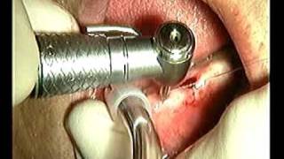 Monoimplante  Monoblock Implant [upl. by Mic]