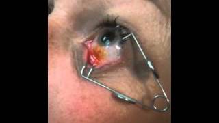 Eye Injection Procedure [upl. by Clemen]