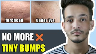 Get Rid Of Tiny Bumps On Face  Best Treatment For Tiny Bumps 100 Working [upl. by Gibbons]