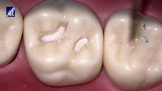 Class I Cavity Preparation Tooth 16 [upl. by Vasyuta]