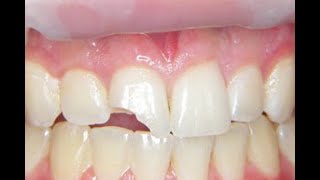 Fix a Chipped or broken tooth at home cheap [upl. by Ymar]