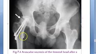 Orthopedics 063 Local Complications of Fracture Part 3 Late Avascular necrosis Sudeck dystrophy [upl. by Herm]