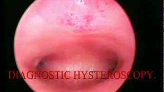 DIAGNOSTIC HYSTEOSCOPY منظار الرحم التشخيصى ED [upl. by Ariana]