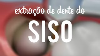 Extração de dente do siso [upl. by Annaiel123]