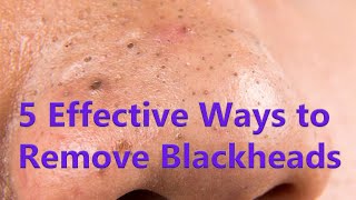 5 Effective Ways to Remove Blackheads [upl. by Chancelor]