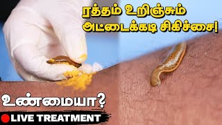 Leech Therapy  அட்டைய கடிக்க விட்டு சிகிச்சையா😱  This is how Leech Therapy Done  Live Treatment [upl. by Atinomar587]