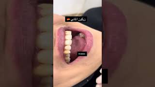 طربوش اسنان الزيركون drabdullahsultandentist dentist orthodontics [upl. by Aihsilef223]