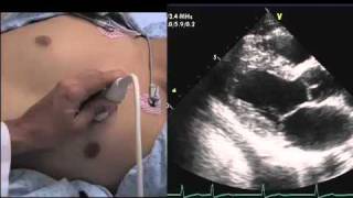 Echocardiography How to Find a Windowmov [upl. by Siuqramed144]