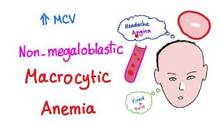 Nonmegaloblastic Macrocytic Anemia [upl. by Griz746]