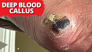 Is A Blood Callus Dangerous Satisfying Debridement [upl. by Susie]