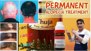 5 Best Homeopathic Medicine For Alopecia Areata Permanent Treatment  Regrow New Hair [upl. by Canice]