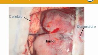 NeurorgsnetMeningioma parasagital frontoparietal [upl. by Rocker833]