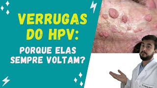 Porque as verrugas do HPV podem voltar [upl. by Teodor423]