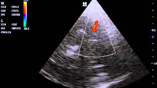 transcranial doppler of RT MCA in severe brain oedema with prominent pulsation [upl. by Murdock433]