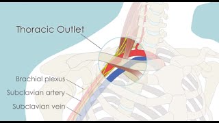 Transaxillary First Rib Resection for Thoracic Outlet Syndrome TOS [upl. by Webb]