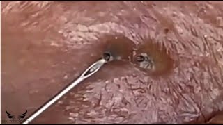 Severe Eye Blackhead Removal  Acne Cystic Treatment Spa  Pimple Popping Elderly Acne Remove  056 [upl. by Colier845]