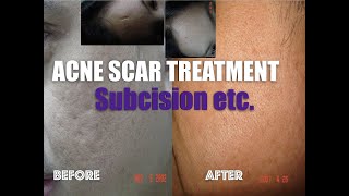 Acne scar treatment before and after  A compilation of scar treatments done by Dr Julieta Arambulo [upl. by Pyotr]