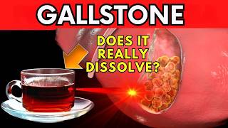 SYMPTOMS OF GALLSTONES  Is there a way to NATURALLY eliminate gallstones cholelithiasis [upl. by Aylward]