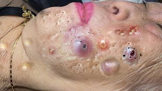 new blackheads this week [upl. by Ekal625]