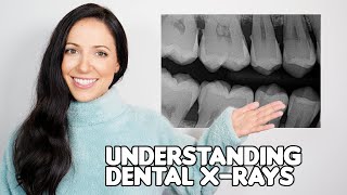 How To Understand Your Dental Xrays Dental Hygienist Explains [upl. by Lelah357]