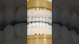 Lower Zen Enamel Zirconia Restoration EnvisiontecMain envisiontec lsk121shorts dentistteeth [upl. by Atinit]