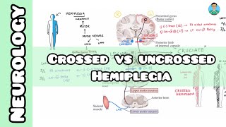 Crossed VS Uncrossed Hemiplegia  Neurology  USMLE NCLEX [upl. by Schulze]