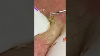 Pickel Ausdrücken Blackheads Mitesser Entfernung 🔴 62 [upl. by Nayr570]