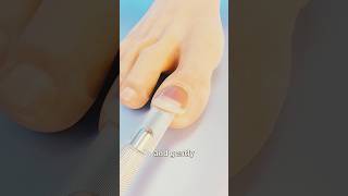 How Toenail Removal Works 😱 [upl. by Joash]