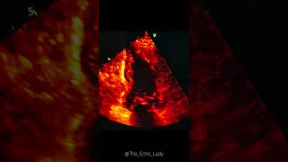 Whats the EF 🤔 echocardiography cardiology echocardiogram [upl. by Ralyt]