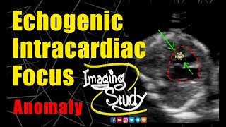 Echogenic Focus EIF Definition Causes Treatment [upl. by Saref]