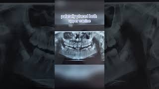 Palatally placed canine orthodontic centre Dr Babita verma MDS DO Dr Om prakash  Tanakpur [upl. by Chernow]