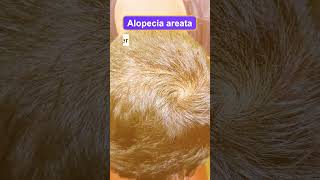 Alopecia areta  patchy hair loss  Tak poka druttamkumarlenka hair alopeciacure r [upl. by Ahsiakal235]